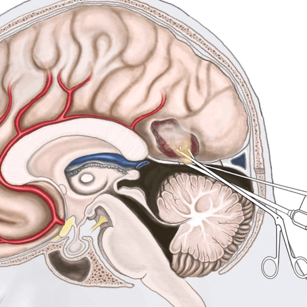 illustration of a brain surgery