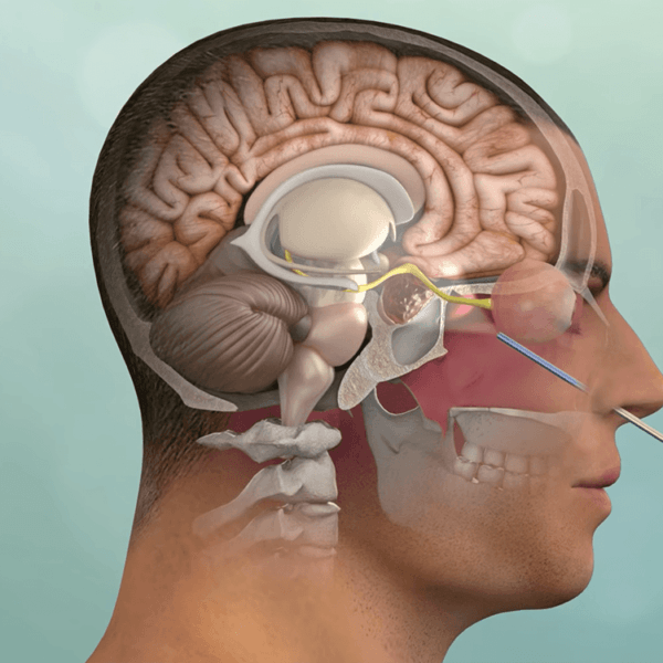 illustration of a procedure done via the nose