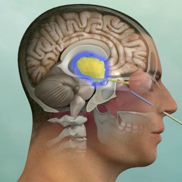 rendering of a procedure being performed via the nasal passage