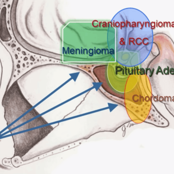 rendering of a pituitary adenoma