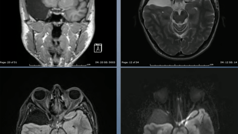 four scans of a brain