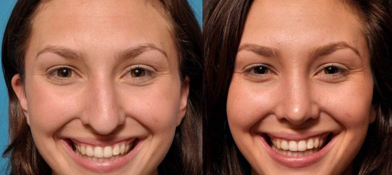 Septorhinoplasty before and after