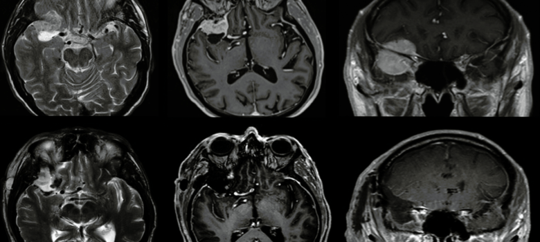 MRI brain tumor
