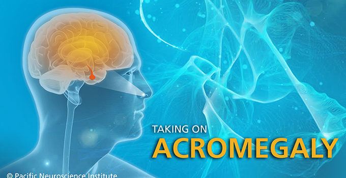 Taking on Acromegaly banner