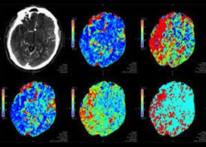 Perfusion Imaging and Thrombectomy