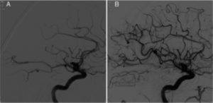 Thrombectomy for M2 occlusions