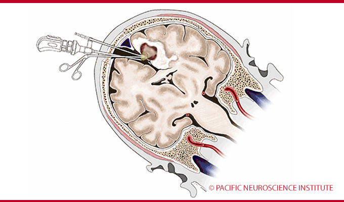 An Illustration of Brain Surgery - Pacific Neuroscience Institute