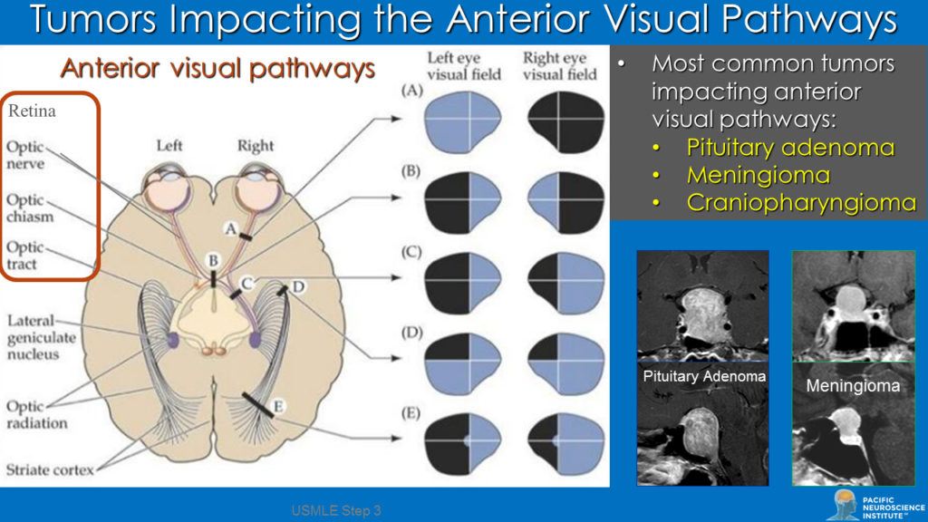 I Can See Clearly Now The Tumor’s Gone | Pacific Neuroscience Institute