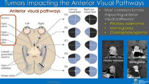 I Can See Clearly Now The Tumor’s Gone Pacific Neuroscience Institute