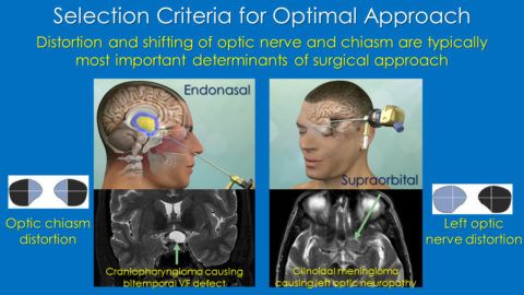 I Can See Clearly Now The Tumor’s Gone Pacific Neuroscience Institute