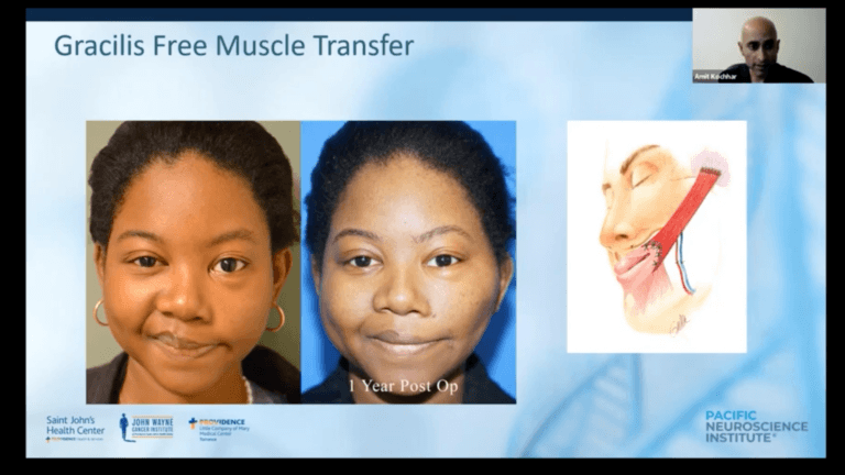 In this installment of the Acoustic Neuroma Association (ANA) Los Angeles Support Group, Dr. Amit Kochhar, MD, presents "Innovations in the Assessment, Education, and Management of Patients with Facial Paralysis." Dr. Kochhar, MD, is double board-certified in Otolaryngology, Head and Neck Surgery and Facial Plastic and Reconstructive Surgery. He is the director of the Facial Nerve Disorders Program at Pacific Eye, Ear & Skull Base Center, Pacific Neuroscience Institute, Providence Saint John’s Health Center in Santa Monica.