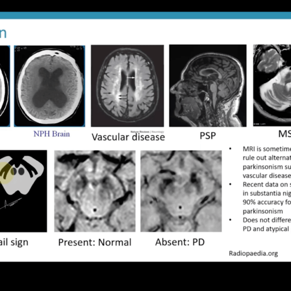 Melita Petrossian, MD, Director of the Pacific Movement Disorders Center, discusses Parkinson's related disease (PD) related conditions and mimics, including idiopathic Parkinson's disease, Multiple Symptoms Atrophy (MSA), Progressive Supranuclear Palsy (PSP), Corticobasal syndrome (CBS), and other rarer conditions. Parkinsonian syndromes may overlap and appear similar in the early stages. Learn about the diagnostic criteria for Parkinson’s disease (PD), including the accuracy of a clinical diagnosis, biomarkers, and anticipated diagnostic tests. PNI’s Movement Disorders Center is here for you and your care partners throughout your journey.