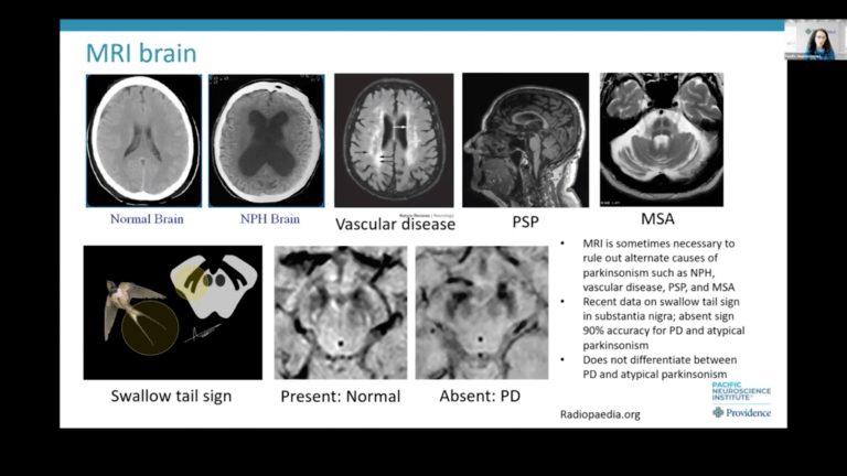 Melita Petrossian, MD, Director of the Pacific Movement Disorders Center, discusses Parkinson's related disease (PD) related conditions and mimics, including idiopathic Parkinson's disease, Multiple Symptoms Atrophy (MSA), Progressive Supranuclear Palsy (PSP), Corticobasal syndrome (CBS), and other rarer conditions. Parkinsonian syndromes may overlap and appear similar in the early stages. Learn about the diagnostic criteria for Parkinson’s disease (PD), including the accuracy of a clinical diagnosis, biomarkers, and anticipated diagnostic tests. PNI’s Movement Disorders Center is here for you and your care partners throughout your journey.