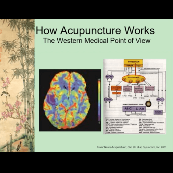 Pacific Neuroscience Institute hosted guest speaker Lucy Postolov, Doctor of Acupuncture and Chinese Medicine, DACM, L.Ac., to discuss acupuncture and integrative medicine as a support system for brain tumor treatment. The webinar was hosted by RJ Mallari, PNI Scientific Writer.