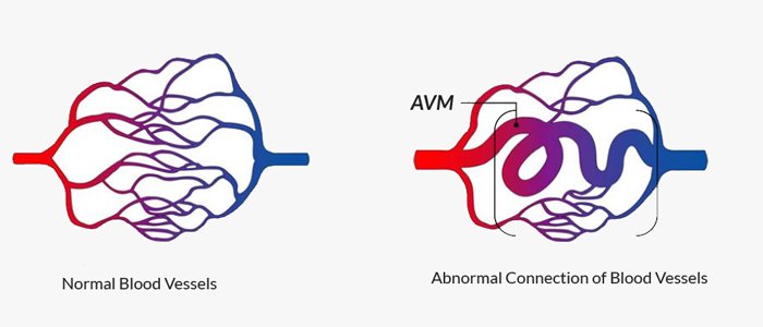 Arteriovenous malformation AVM