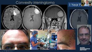Pacific Neuroscience Institute patient treatment approach with convexity meningioma
