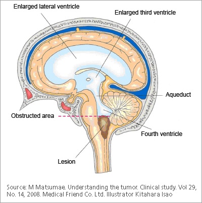 Obstructed Hydrocephalus