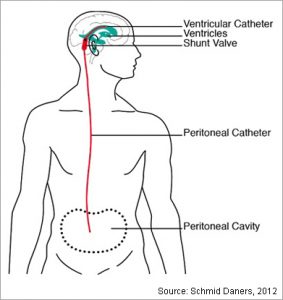 Ventriculoperitonial Shunt  Pacific Adult Hydrocephalus Center