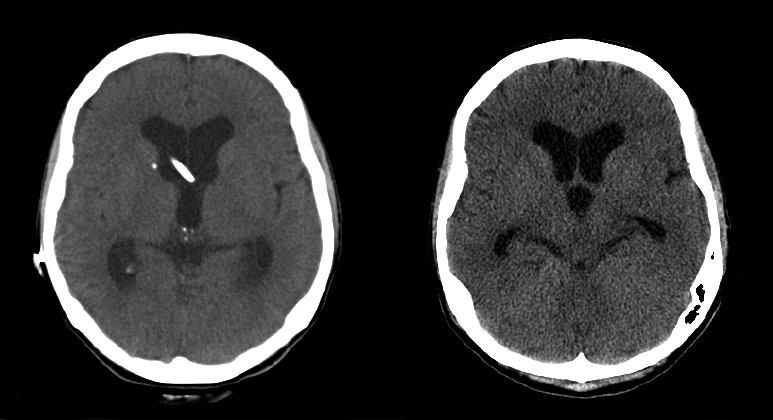 Ventriculoperitonial Shunt  Pacific Adult Hydrocephalus Center