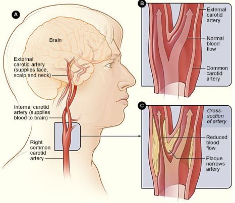 carotid artery disease