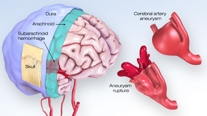 Subarachnoid Hemorrhage (SAH) - Willis-Knighton Health System