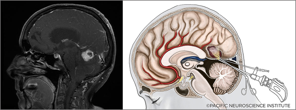 Minimally-invasive keyhole approach to treating hemangioblastomas.
