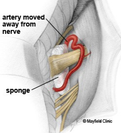 artery moved