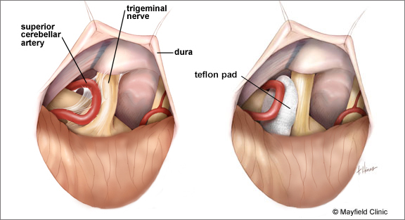 Microvascular Decompression Surgery
