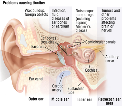 Afwijzen Regeneratie enkel Hearing Loss & Tinnitus Symptoms, Diagnosis & Treatment | Pacific Eye & Ear  Center