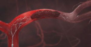 Stent Retriever | Source: Stryker Inc.